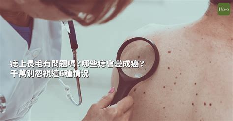 痣的毛可以拔嗎|痣上長毛有問題嗎？哪些痣會變成癌？千萬別忽視這6種情況